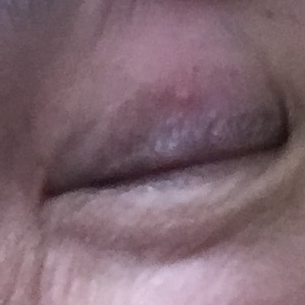 上瞼（うわまぶた）の稗粒腫が取れた直後の皮膚